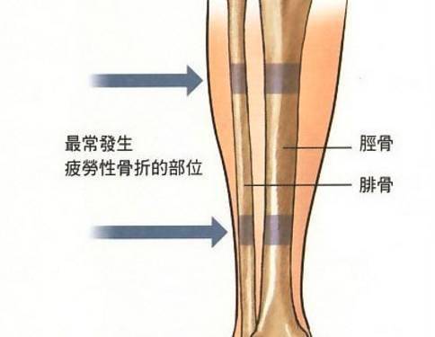 胫骨肌腱炎能认定工伤吗