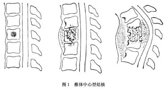 胸椎结核感染：工作环境中患结核病工伤认定详解及案例分析