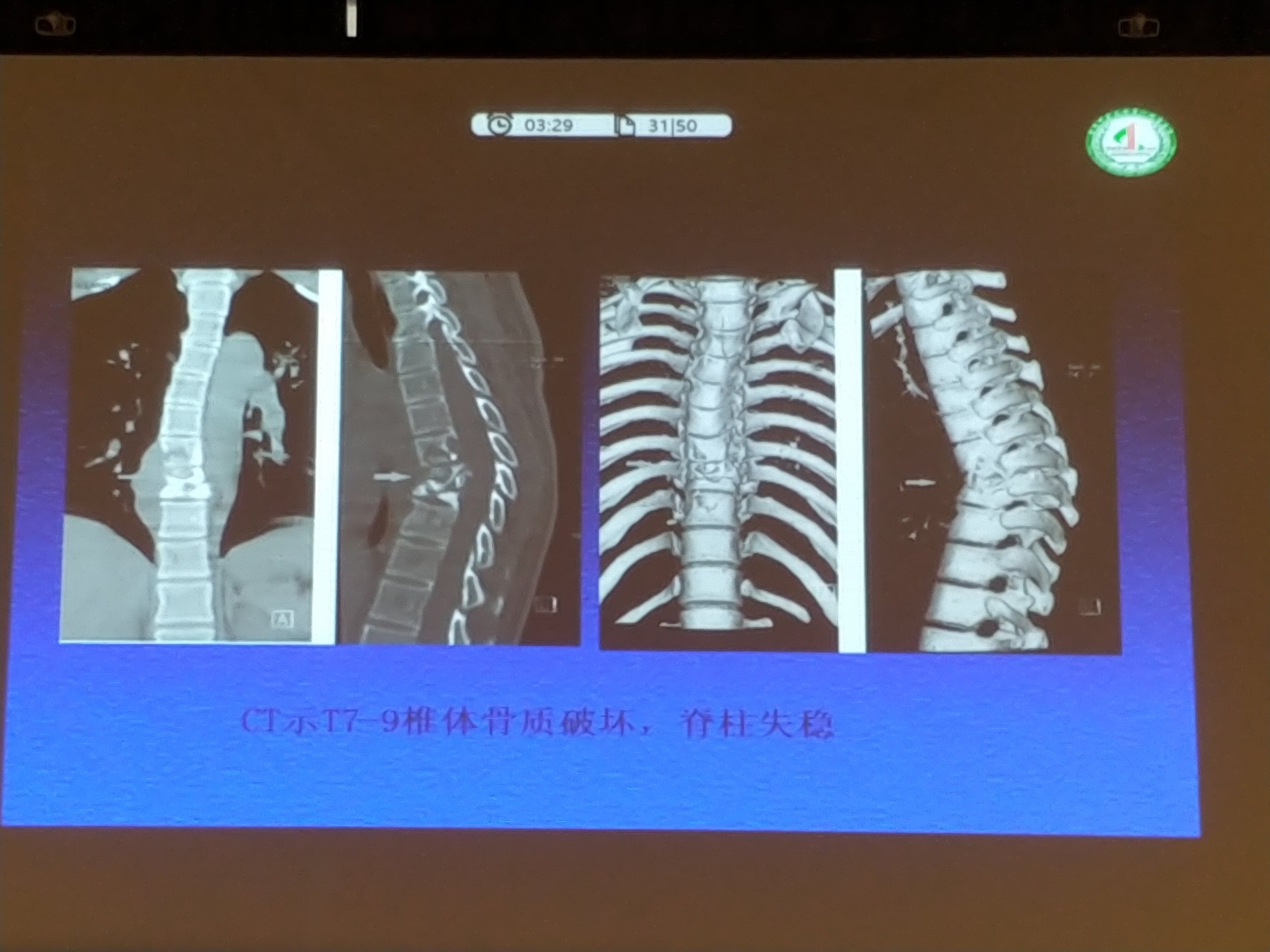 胸椎结核感染：工作环境中患结核病工伤认定详解及案例分析