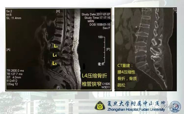 脊柱压缩性骨折工伤认定及赔偿标准详解