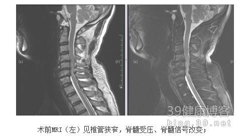 脊柱压缩性骨折：恢复过程、治疗选择与时间线解析