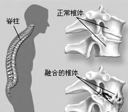 脊柱压缩性骨折：恢复过程、治疗选择与时间线解析