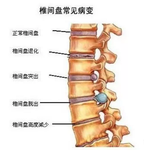 脊柱压缩性骨折：恢复过程、治疗选择与时间线解析