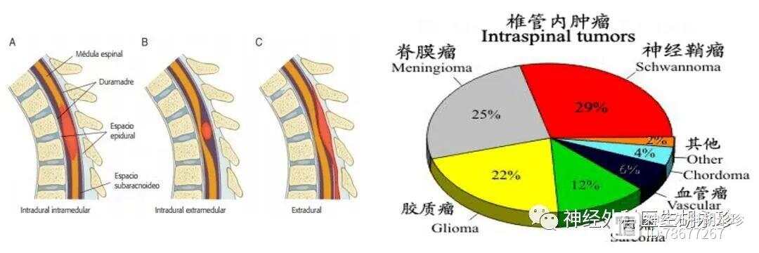 脊柱肿瘤能手术吗：治疗费用、存活期及非手术疗法探讨