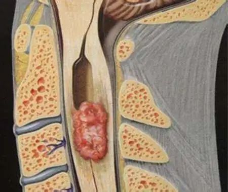 脊柱肿瘤能手术吗：治疗费用、存活期及非手术疗法探讨