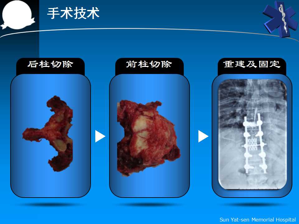 脊柱肿瘤切除手术：探讨治疗可能性与手术方案