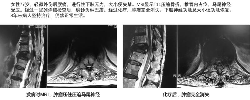 脊柱肿瘤可以认定工伤吗