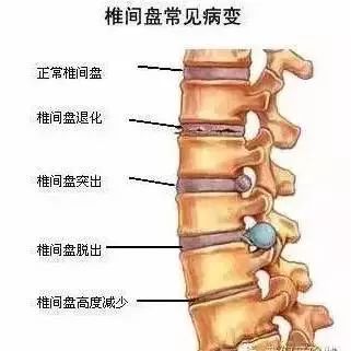 脊椎移位引发瘫痪风险：何时需要警惕？