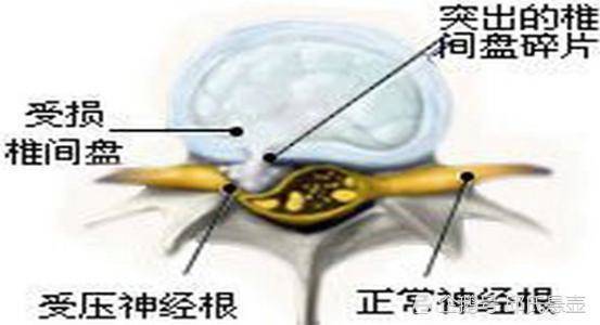 脊椎移位的自我修复方法与全面防治策略