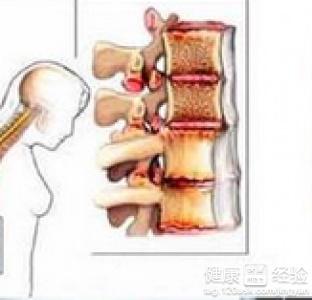 脊椎细菌感染能恢复吗：男女性治疗及注意事项，常用推荐