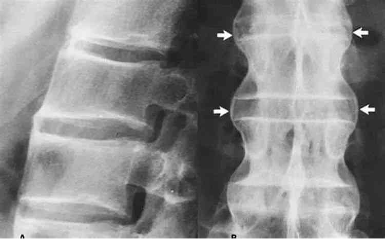 细菌性脊柱炎：症状、诊断与全面治疗方案解析