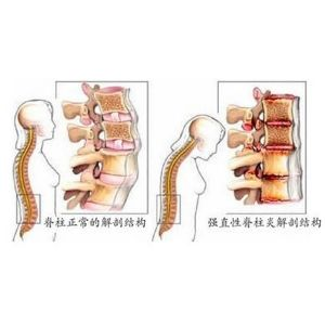 细菌性脊柱炎：症状、诊断与全面治疗方案解析