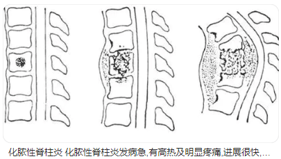 脊柱感染一般有哪些细菌及其引起的病概述