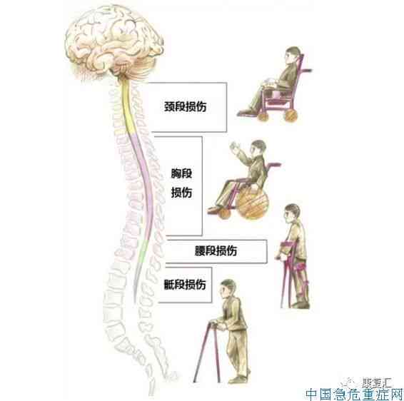 脊髓炎能认定工伤吗