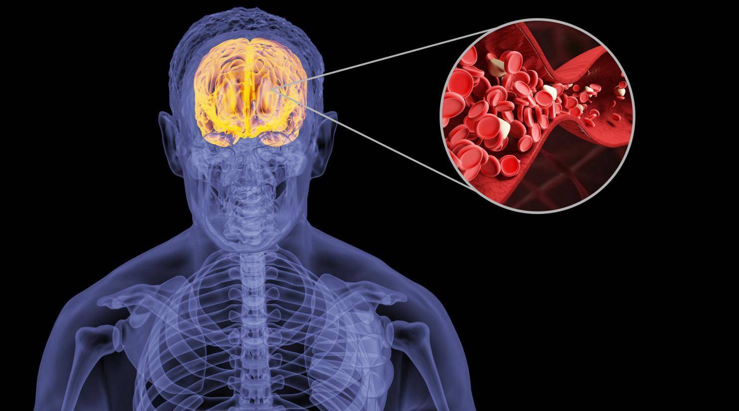 脑出血植物人怎么办：能否恢复正常、状态与症状、存活时间及受罪情况解析