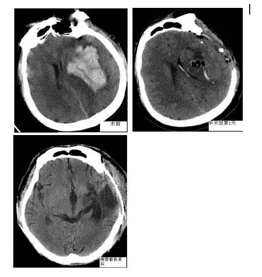 脑出血植物人怎么办：能否恢复正常、状态与症状、存活时间及受罪情况解析