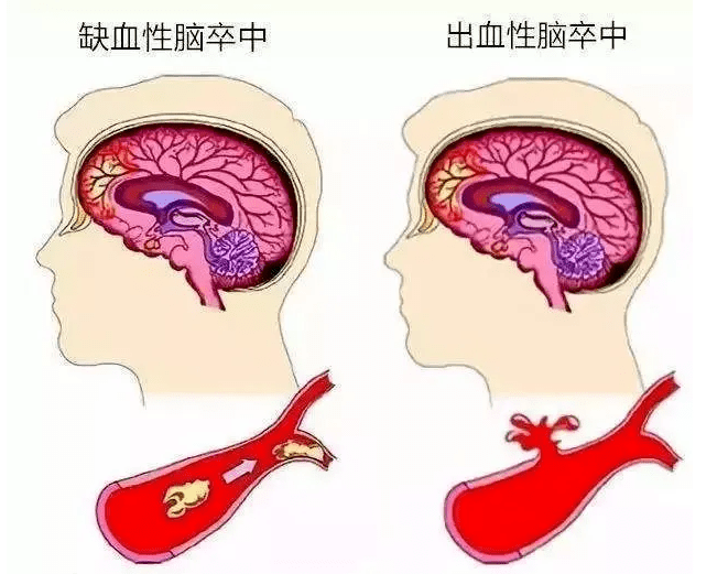 关键期限：脑出血导致的植物人状态生存期限与生活质量探讨