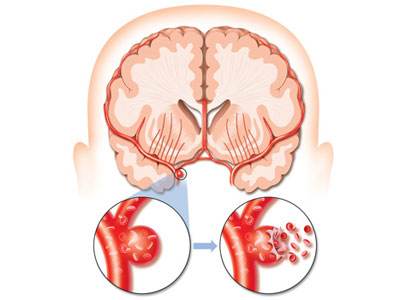 脑出血植物人能恢复正常人吗：恢复可能性及生存期限解析