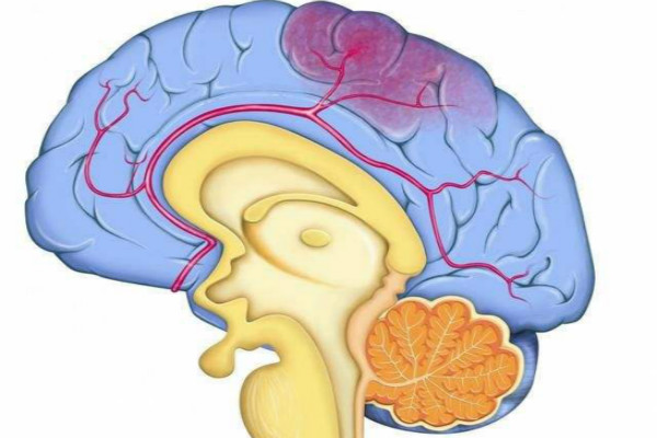 脑出血植物人能恢复正常人吗：恢复可能性及生存期限解析