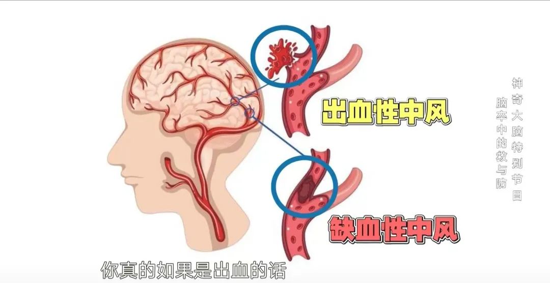 脑出血瘫痪算残疾吗：能否治愈、寿命预期及评残标准解析