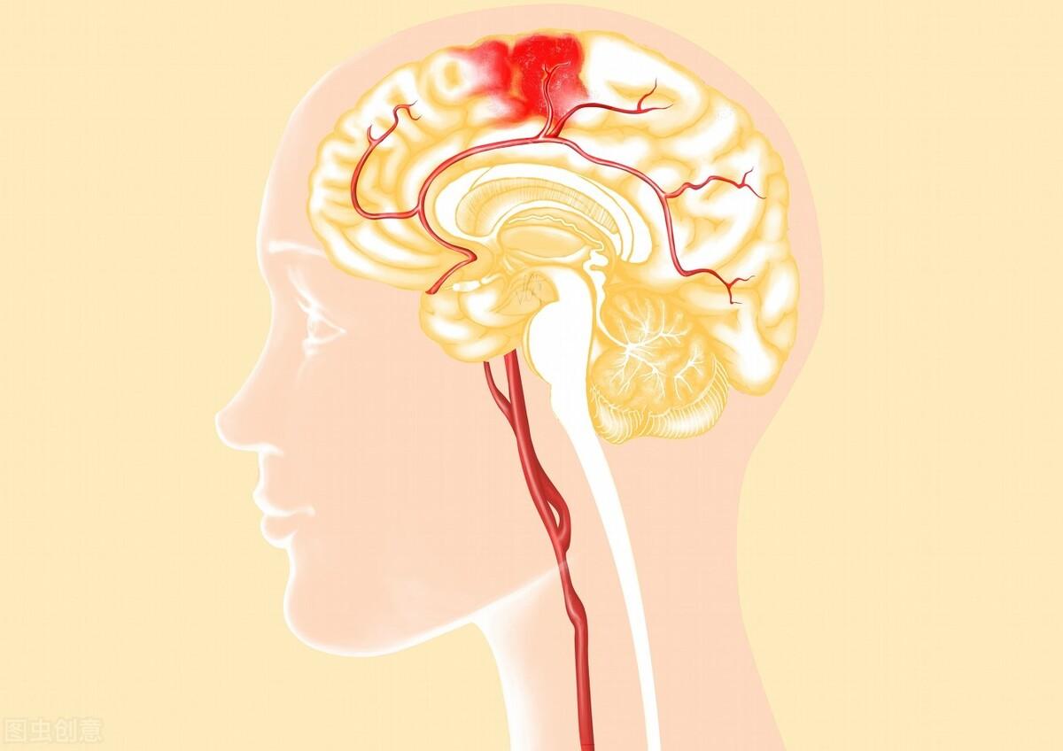 工伤脑出血赔偿标准一览：认定流程、伤残等级划分与赔偿金额详解