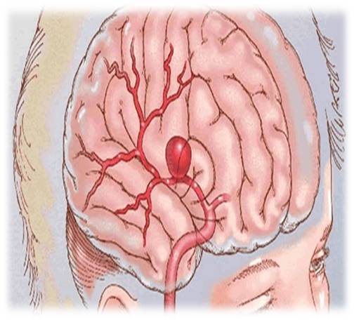 探讨脑动脉瘤破裂是否合工伤认定标准