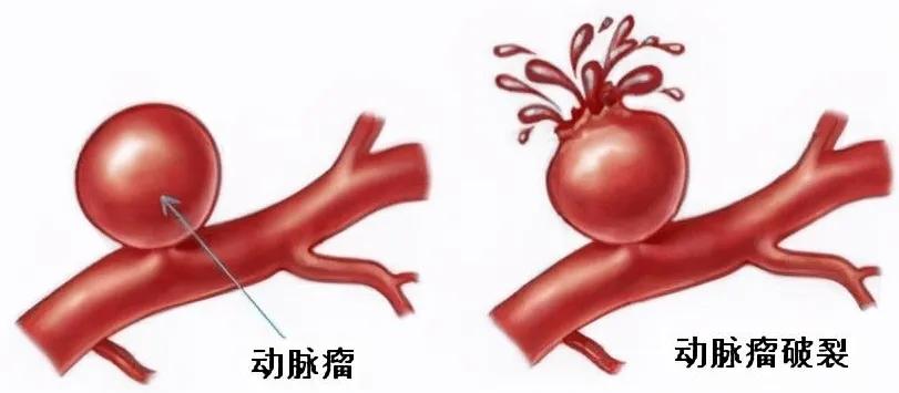 探讨脑动脉瘤破裂是否合工伤认定标准