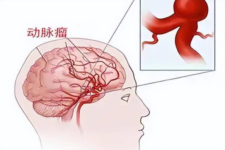 脑动脉瘤破裂算重大疾病吗：治疗难度与风险解析