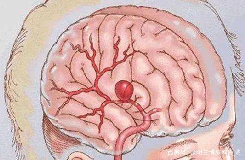 脑动脉瘤破裂算重大疾病吗：治疗难度与风险解析