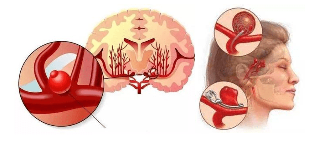 脑动脉瘤破裂算重大疾病吗：治疗难度与风险解析