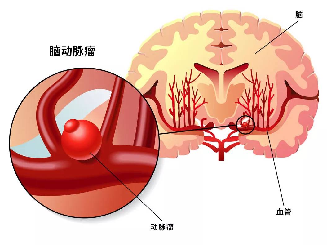 脑动脉瘤破裂算重大疾病吗：治疗难度与风险解析