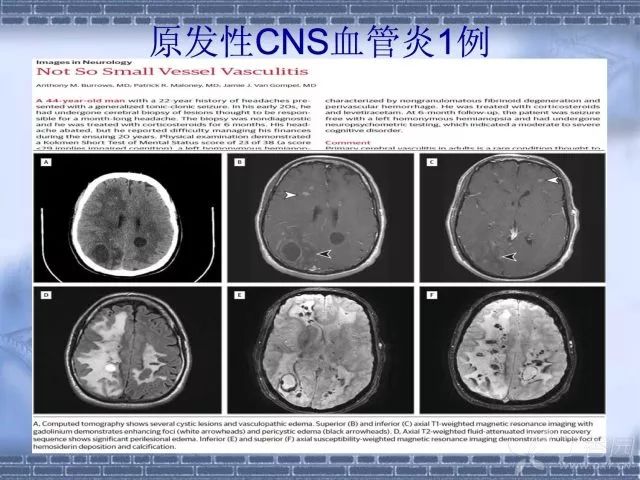 脑卒中属于脑损伤吗：探讨其严重性与是否属于颅脑损伤