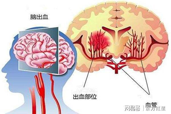 脑卒中属于脑损伤吗：探讨其严重性与是否属于颅脑损伤