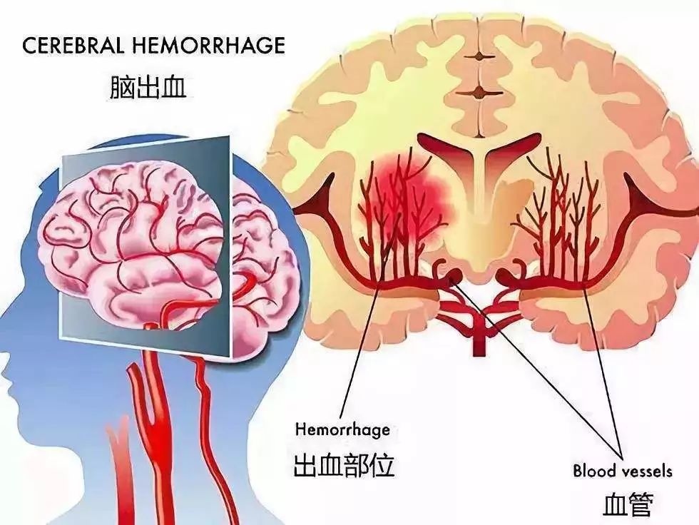 公司因员工脑干出血事故承担赔偿责任