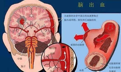 公司因员工脑干出血事故承担赔偿责任