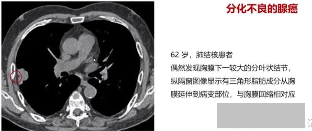 脑干出血属于职业病吗-脑干出血属于职业病吗可以做司法鉴定