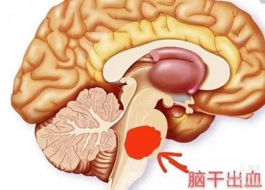 工伤认定新探：脑干出血情形能否被纳入工伤范畴