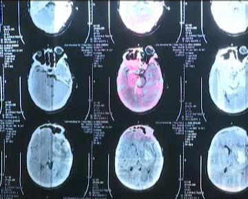 工伤认定新探：脑干出血情形能否被纳入工伤范畴