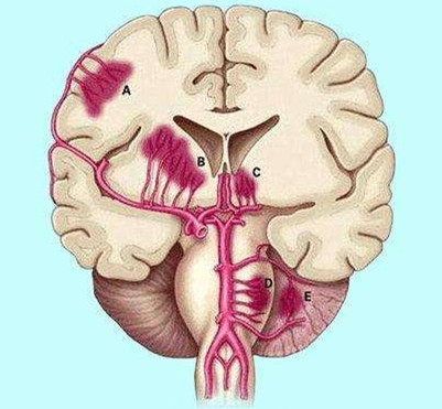 脑干出血是否被归类为重大疾病：全面解析其严重性与治疗指南