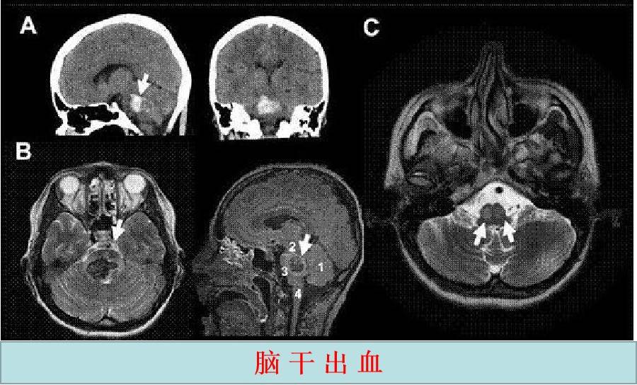 脑干出血是否被归类为重大疾病：全面解析其严重性与治疗指南