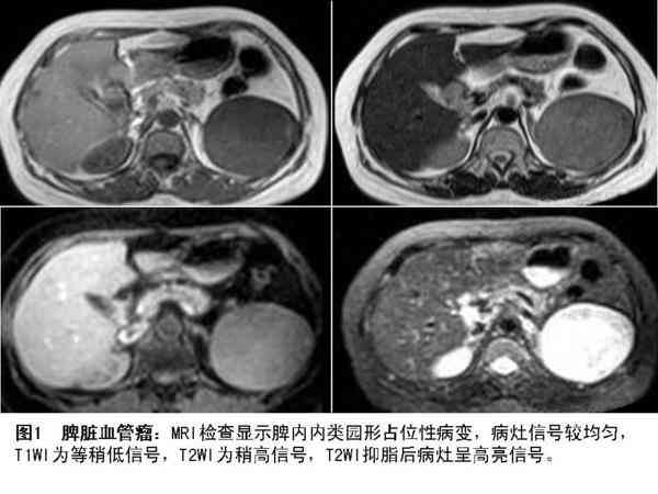 脾血管瘤可以认定工伤吗