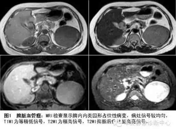 脾血管瘤可以认定工伤吗