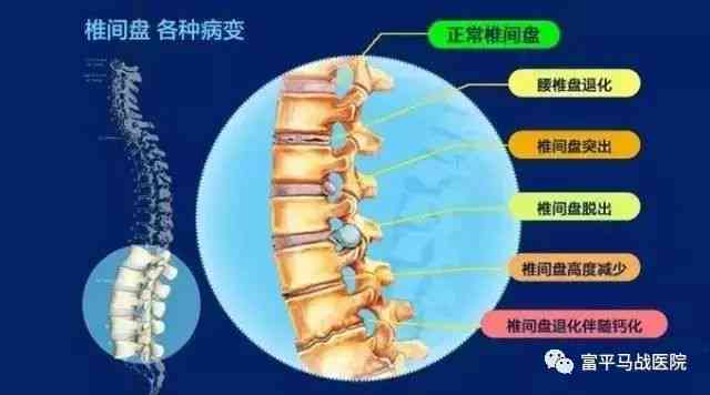 腰椎凸出怎么认定工伤几级