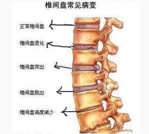 腰椎凸出怎么认定工伤几级