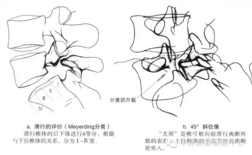 腰椎峡部裂怎样认定工伤