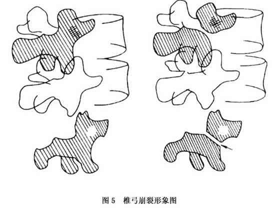 腰椎峡部裂怎样认定工伤