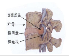 腰椎排列失稳能认定工伤吗