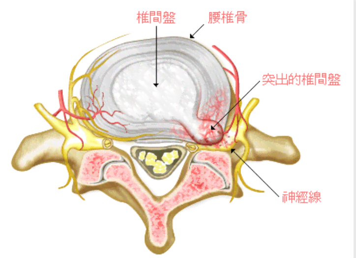 腰椎排列失稳能认定工伤吗