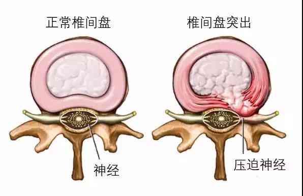 腰椎间盘突出已认定工伤