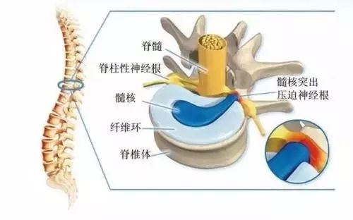 腰椎间盘突出已认定工伤